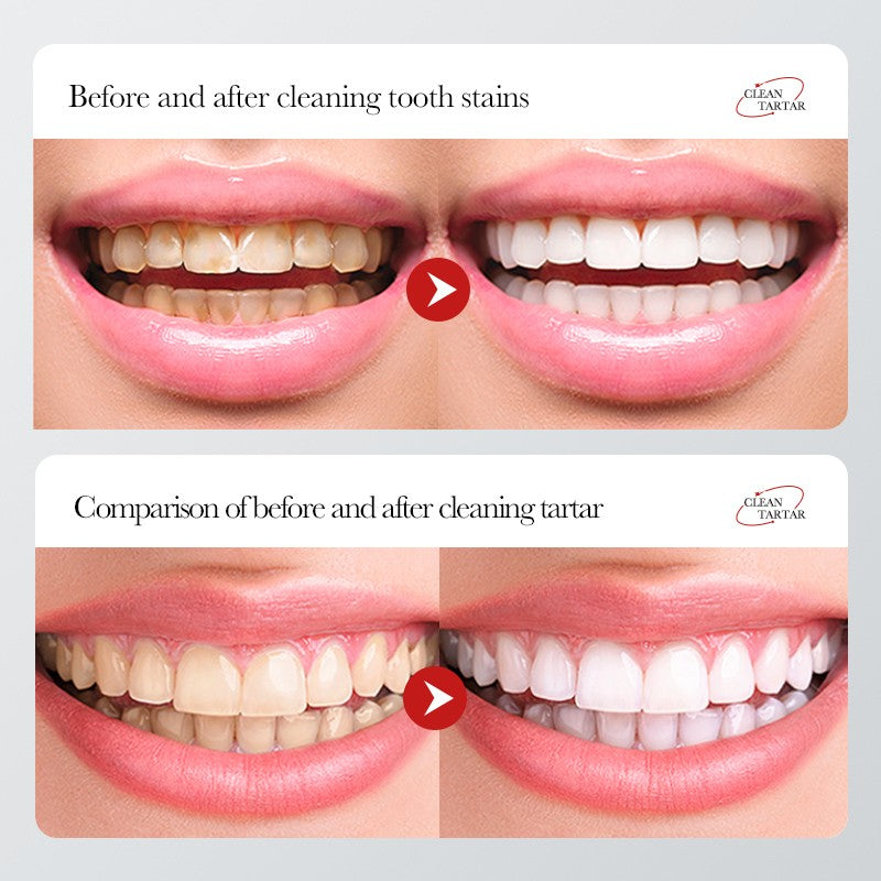 Tooth Stain Removal